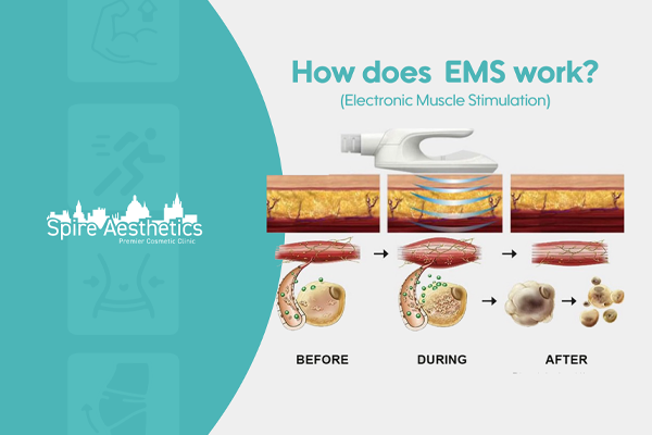EMS treatment for post pregnancy weight loss treatment Lyndhurst