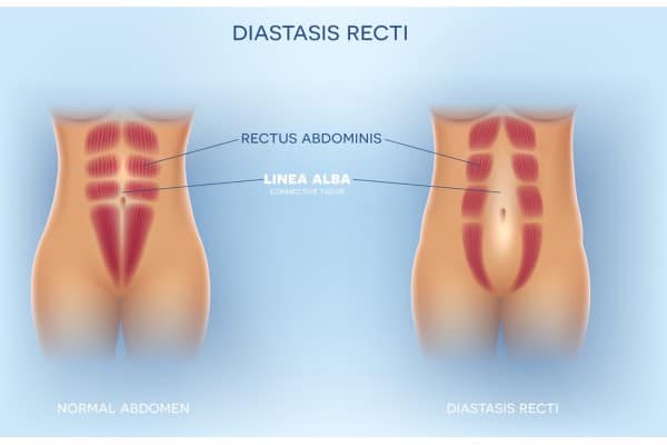 What Non-Surgical Options Are Available for Diastasis Recti Lyndhurst?