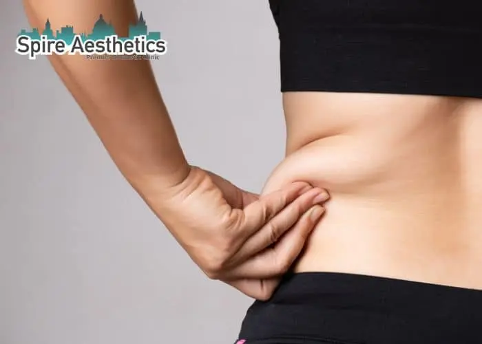 Image of woman pinching fat on their hips Lyndhurst. Fat Freezing treatment