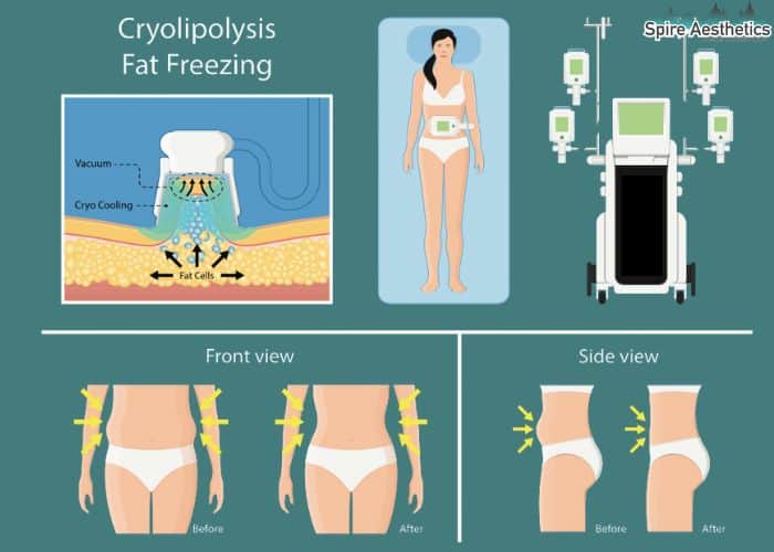 Image of diet and fat freezing combined for best results for Spire Aesthetics Lyndhurst