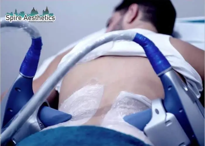 Man having fat freezing treatment done on love handles before a competitions Lyndhurst to create a sculpted look.