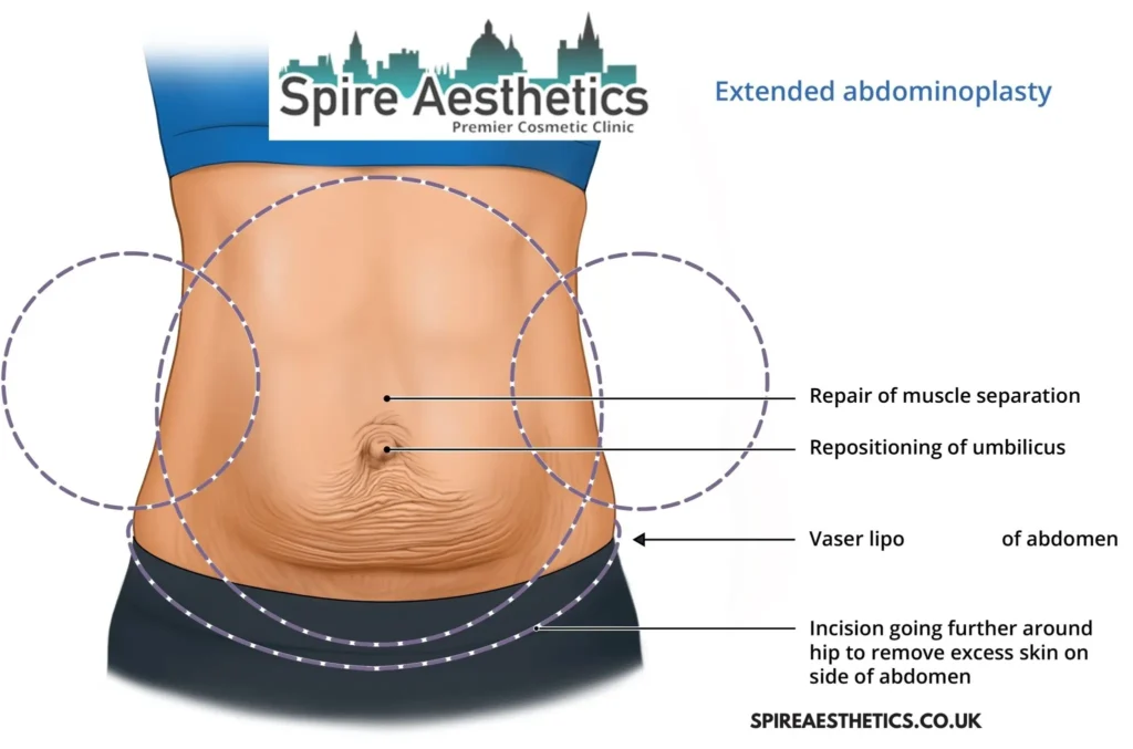 Understanding Loose Skin After Gastric Band Lyndhurst Surgery and HIFU Treatment