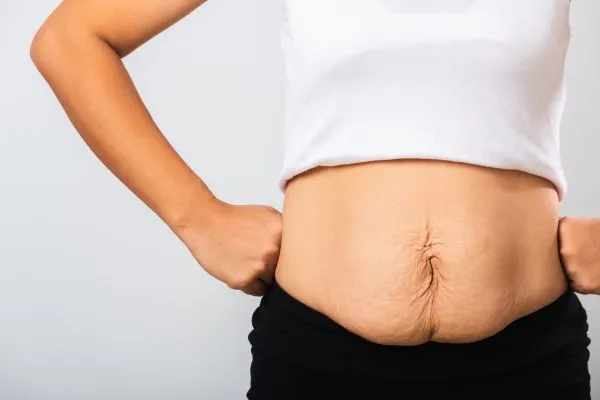 Image of a woman's stomach after weight loss with sagging skin following a gastric band Lyndhurst