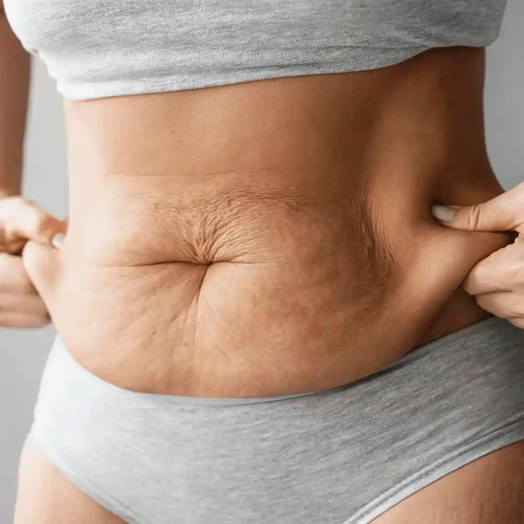 Is It Normal to Have Loose Skin After Pregnancy Lyndhurst?