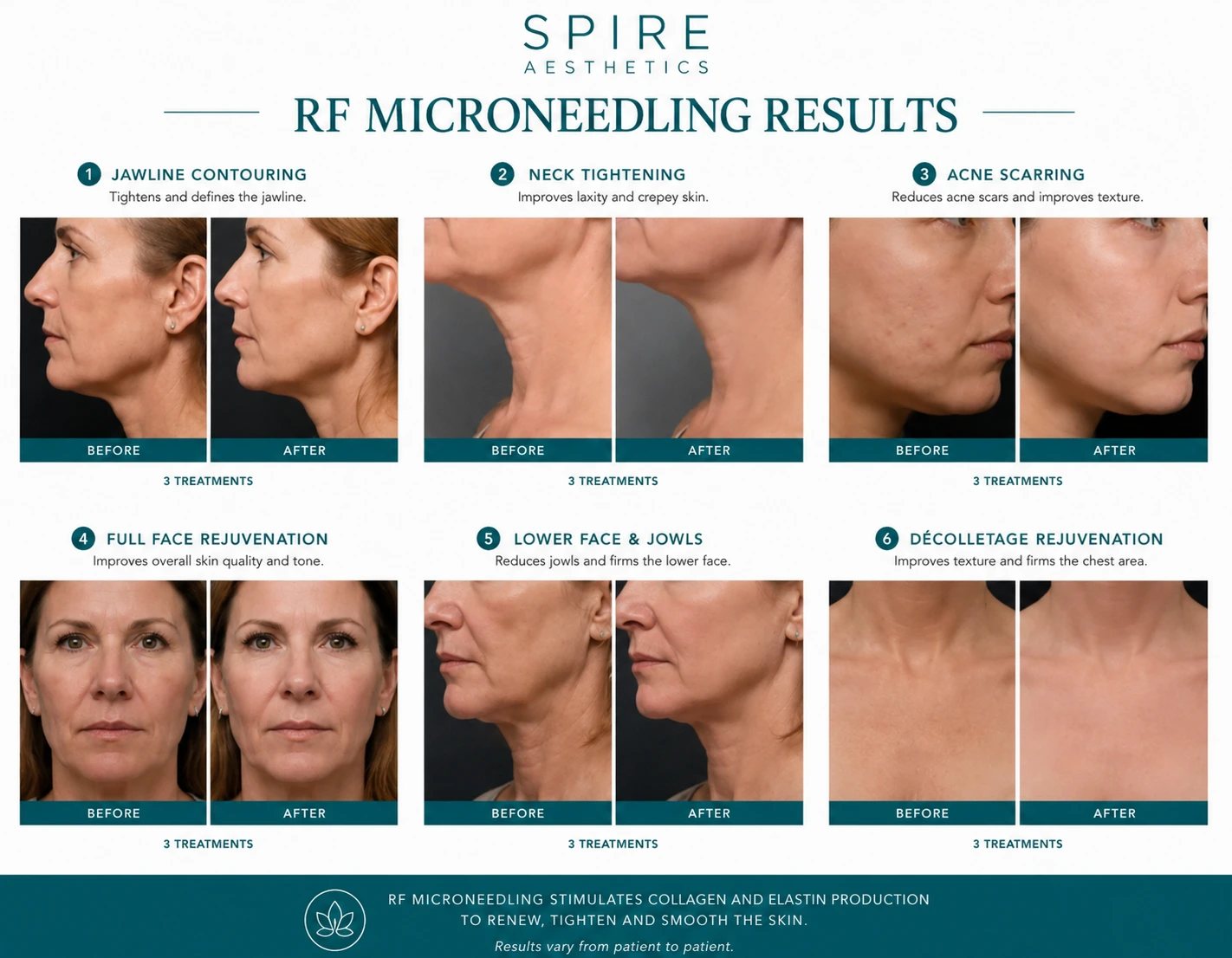 RF Microneedling Skin tightening Lyndhurst results