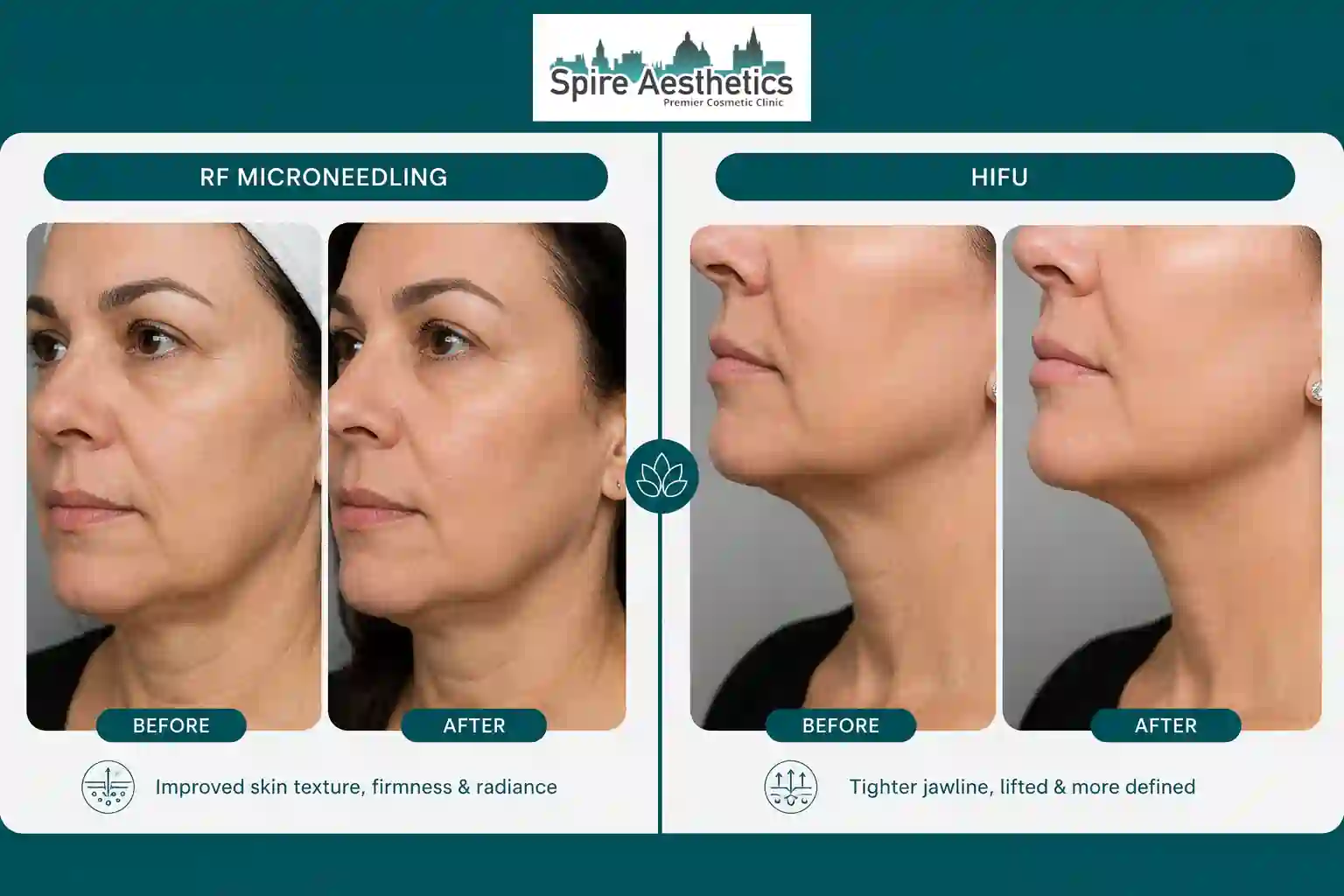 Can RF Microneedling and HIFU Be Combined Lyndhurst?