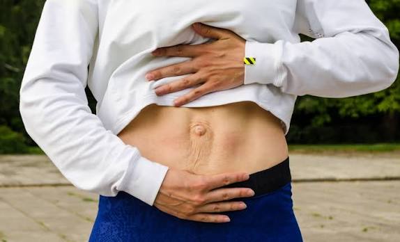When Could Diastasis Recti Be the Missing Piece of the Puzzle Lyndhurst?