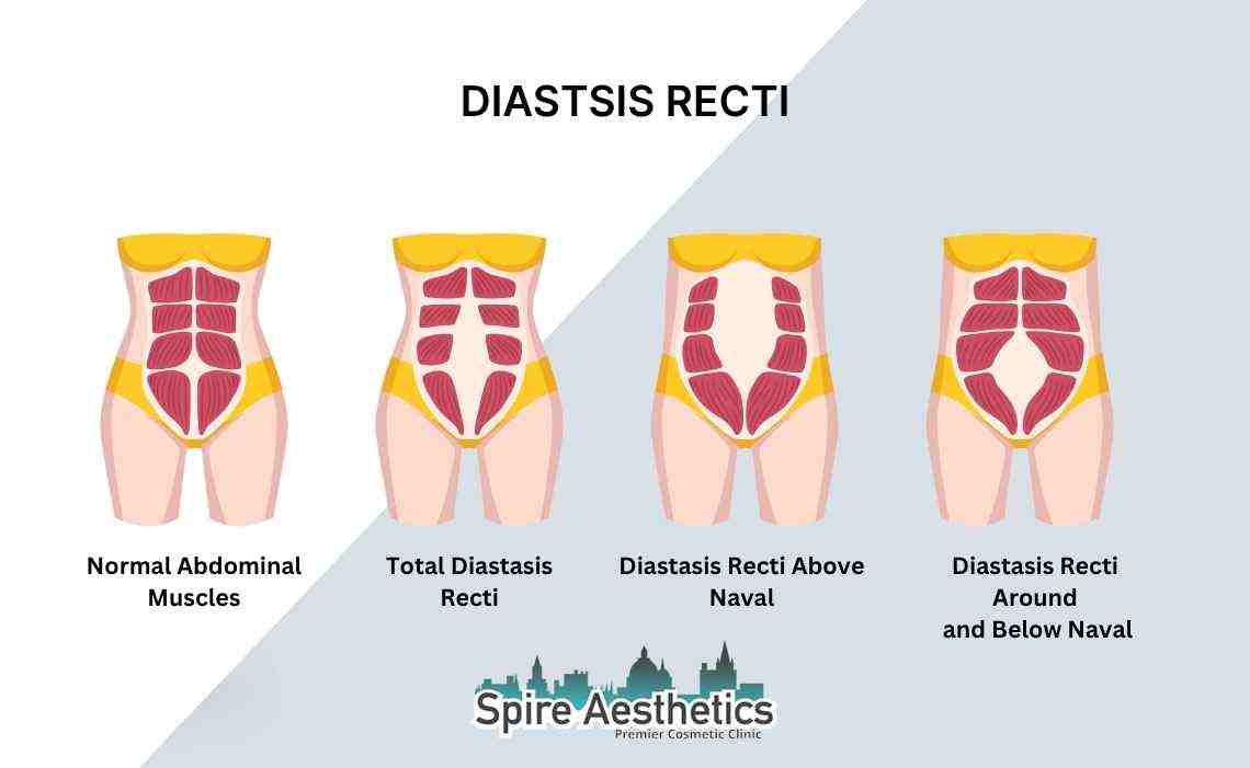Is Non-Surgical Diastasis Recti Treatment Right for You? Common Concerns Answered Lyndhurst